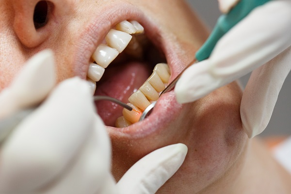 בדיקת שיניים לפני השתלה