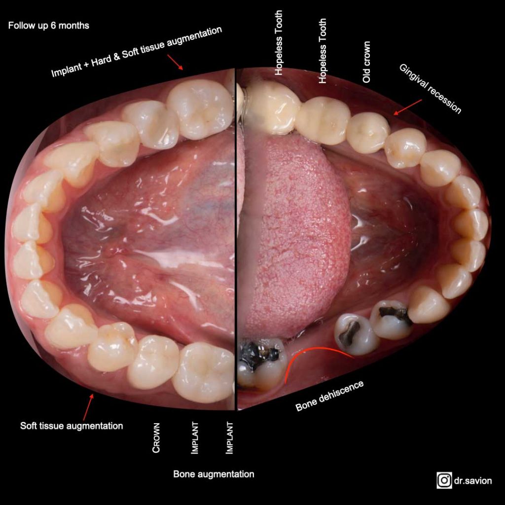 תמונה משולבת של לפני ואחרי בצד שמאל (לפני) ניתן לראות את הדפקט הגרמי וחוסר חניכיים, עם שחזורים לקויים רבים. בצד ימין, ניתן לראות את עובי מצאר החניכיים לאחר שהותקנו שתלים והשתלות חניכיים באותו מעמד.