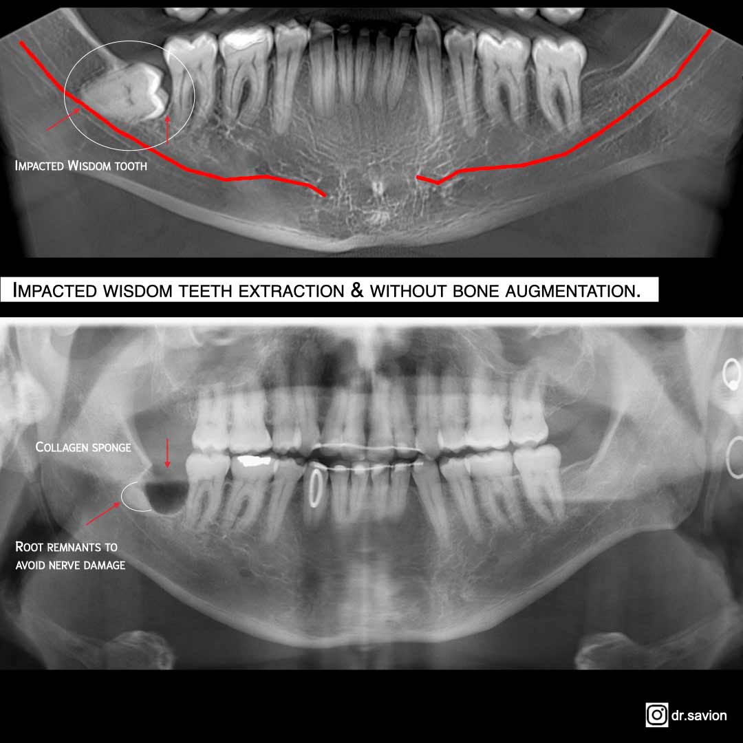 תמונת הדמייה של טיפול עקירת שן בינה כלואה באמצעות שימוש בטכנולוגיית הלייזר תחת מיקרוסקופ טיפולי.