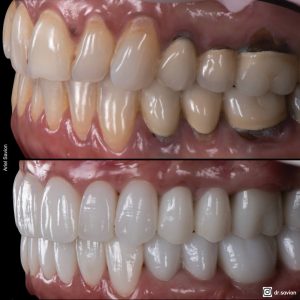 שיניים לאחר הלבנה