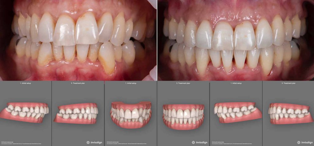 תמונה של שילוב של טיפול בלייזר במחלת חניכיים כרונית, עם יישור שיניים באמצעות קשתיות שקופות ללא סמכים או גומיות.