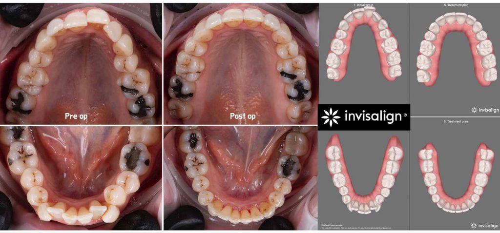 תמונה משולבת של השיניים במצב pre op וpost op בנוסף לתמונה הדמייה של יישור שיניים בלייזר ללא צורך בעקירות שיניים.