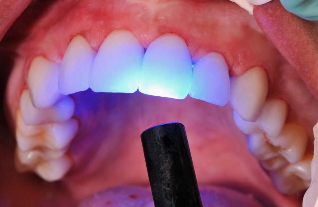 טיפולי שיניים בלייזר