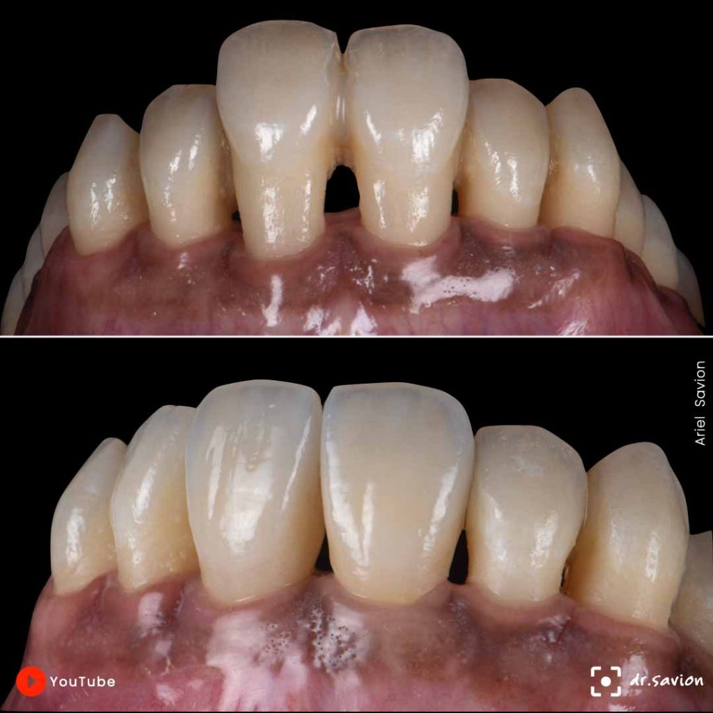 הצגת טיפול שתלים בשילוב לייזר באזור אסתטי: תמונה של לפני ואחרי שיניים תחתונות