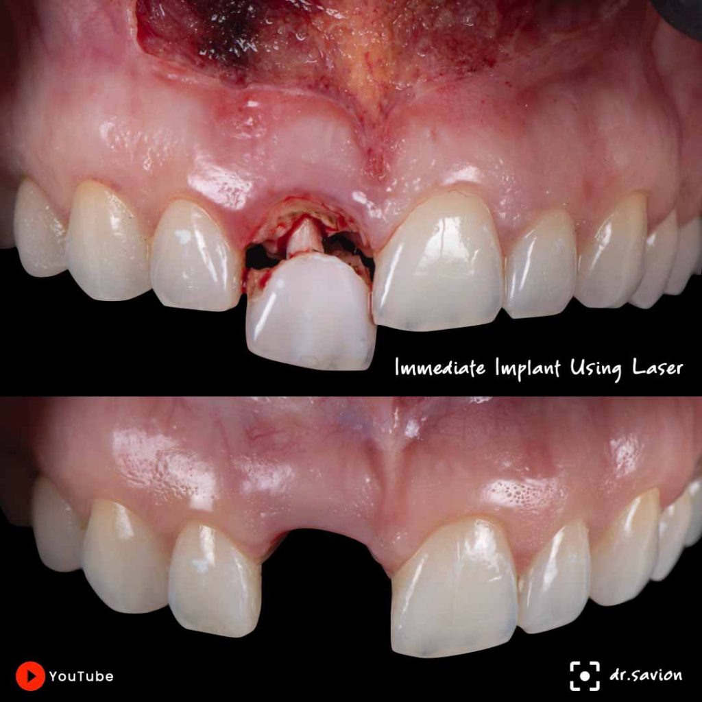 תמונה של שיניים של מטופל במהלך טיפול MLT (microsurgical laser therapy) concept. גישה טיפולית שפותחה על ידי ד״ר אריאל סביון (כל זכויות שמורות) כדי לתת מענה של מעורבות מינימלית עם תוצאה מקסימלית.