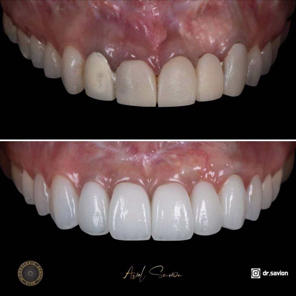 תוצאה של הלבנת שיניים לפני ואחרי אצל ד"ר אריאל סביון