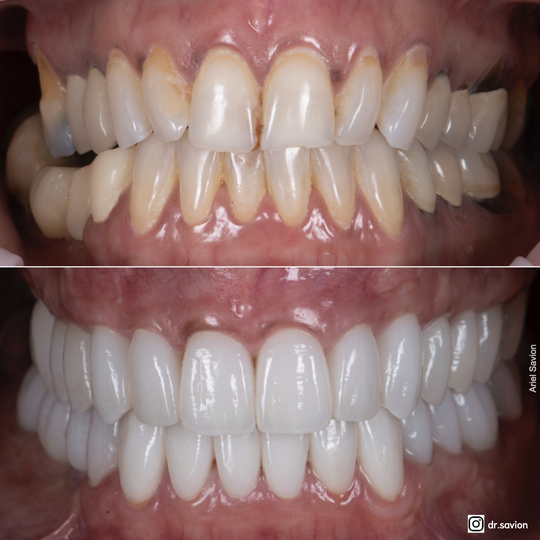 השתלת חניכיים לפני ואחרי