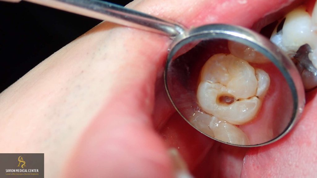 איך מאבחנים עששת במרפאת השיניים סביון מדיקל סנטר