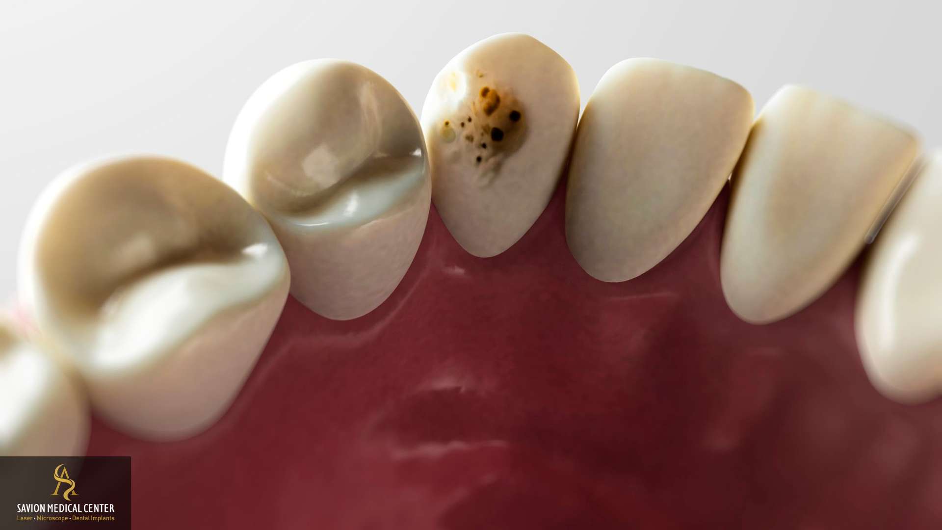 טיפול בעששת בשיניים | סביון מדיקל סנטר