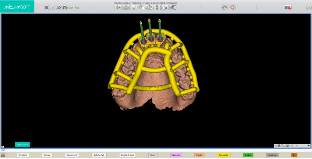 בדיקת תוצאות הצילום CBCT 