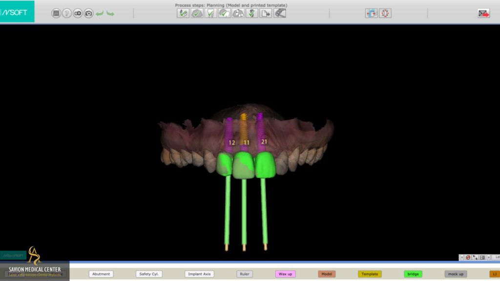 איסוף נתונים וצילומי CBCT סביון מדיקל סנטר