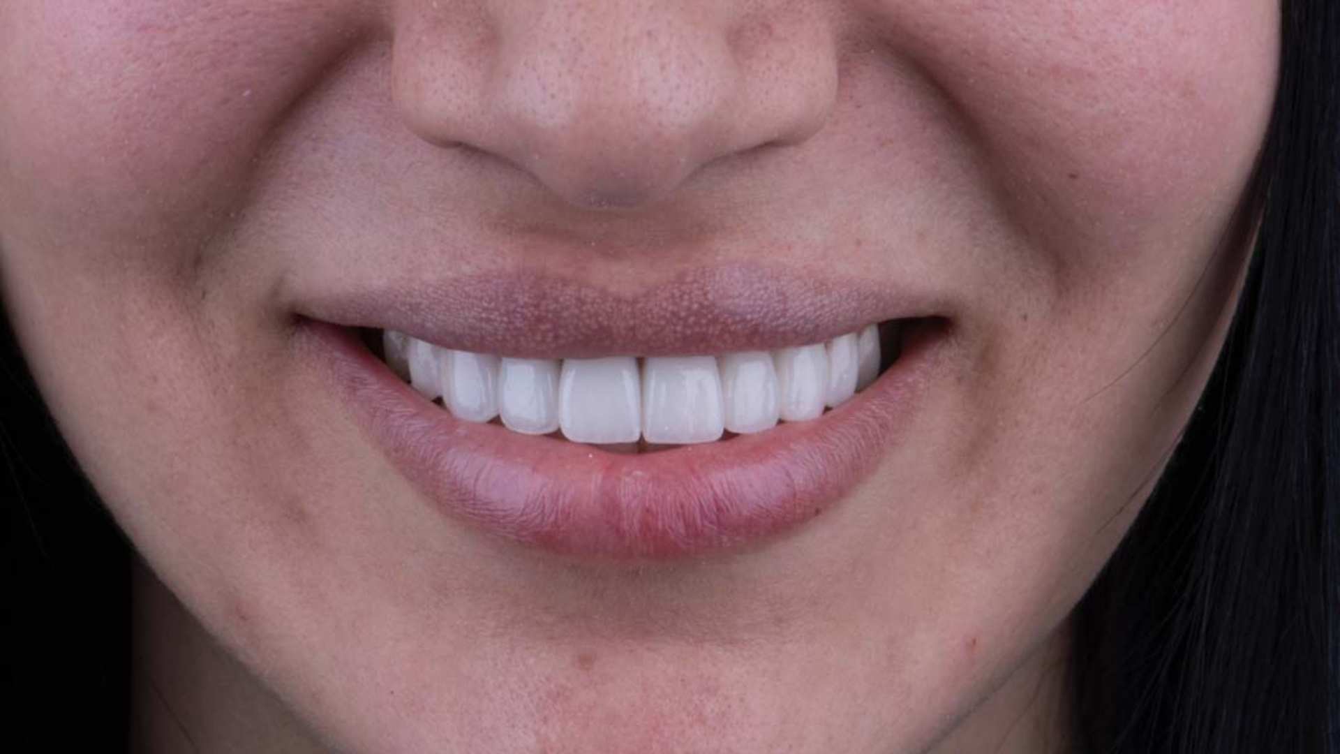 Smile transformation