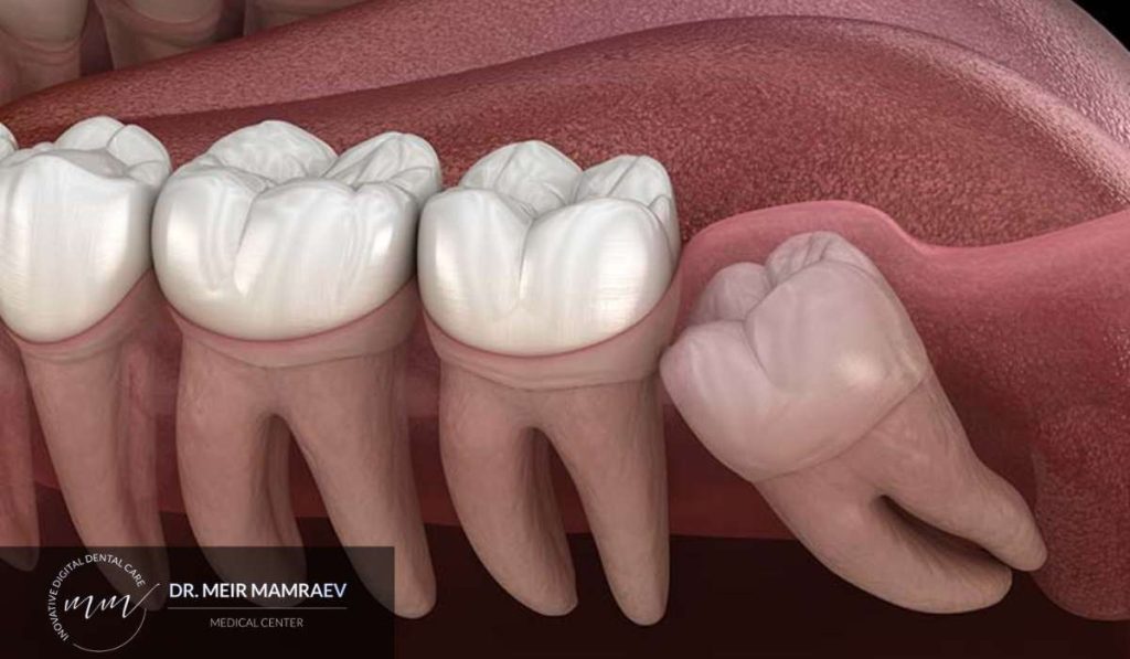 Advanced Impacted Wisdom Teeth Extraction A Comprehensive Guide