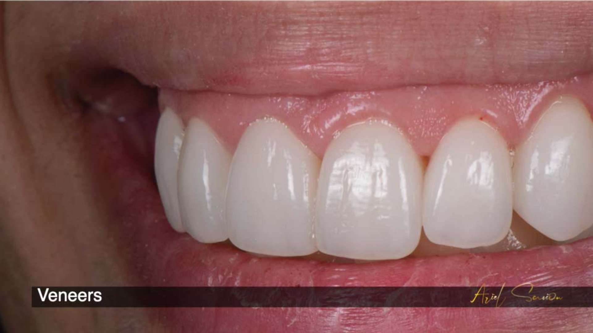 Composite Resin Veneers A Clinical Overview and Patient Guide with Practical Insights