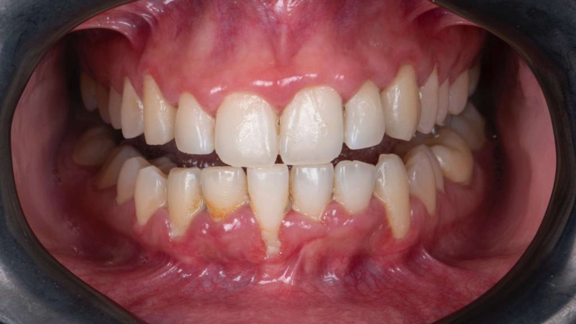 Periodontitis - Saving Natural Teeth with Laser and Emdogain