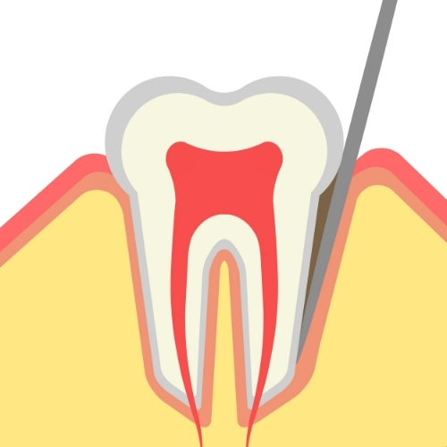 Periodontal pockets Clinical Diagnosis